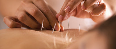 Acupuncture for Subfertility